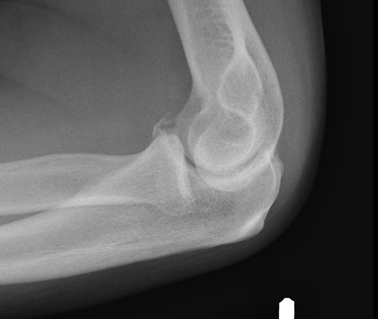 Coronoid Fracture Type 1